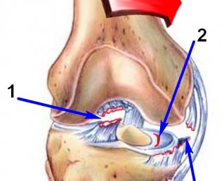Разрыв передней крестообразной связки